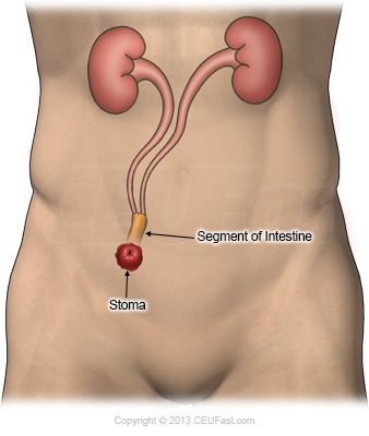 urostoma